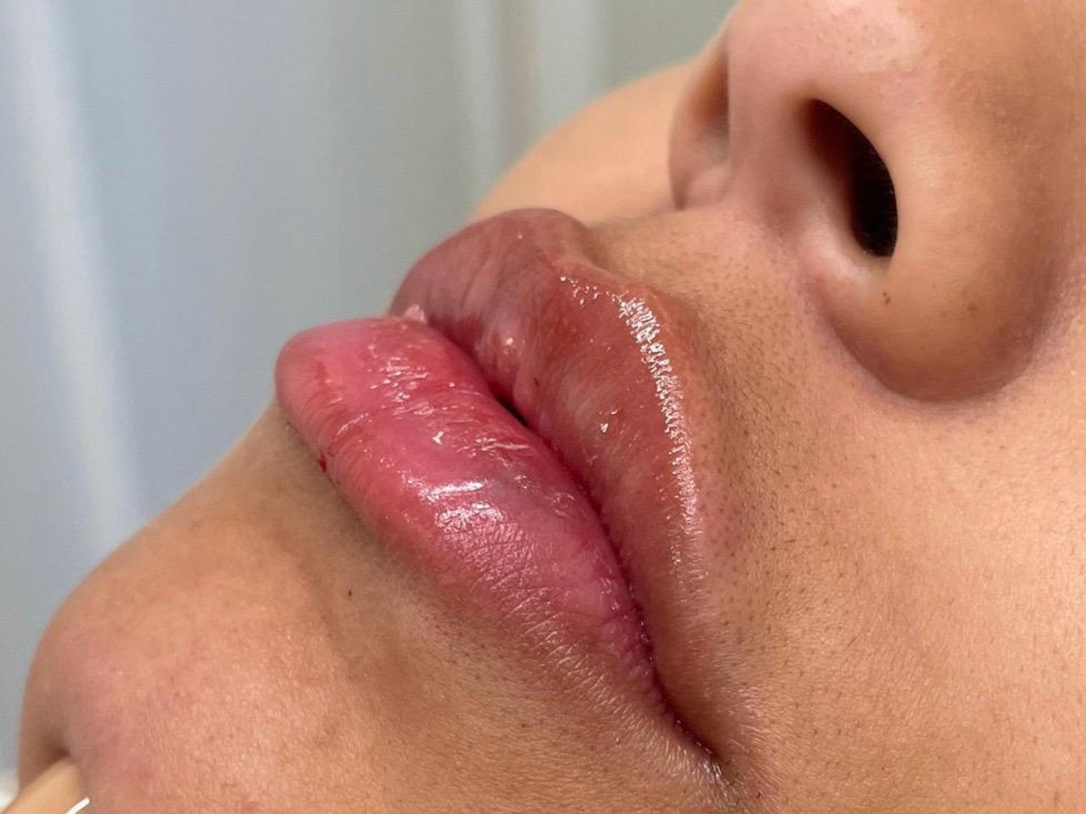 Harmonização Facial